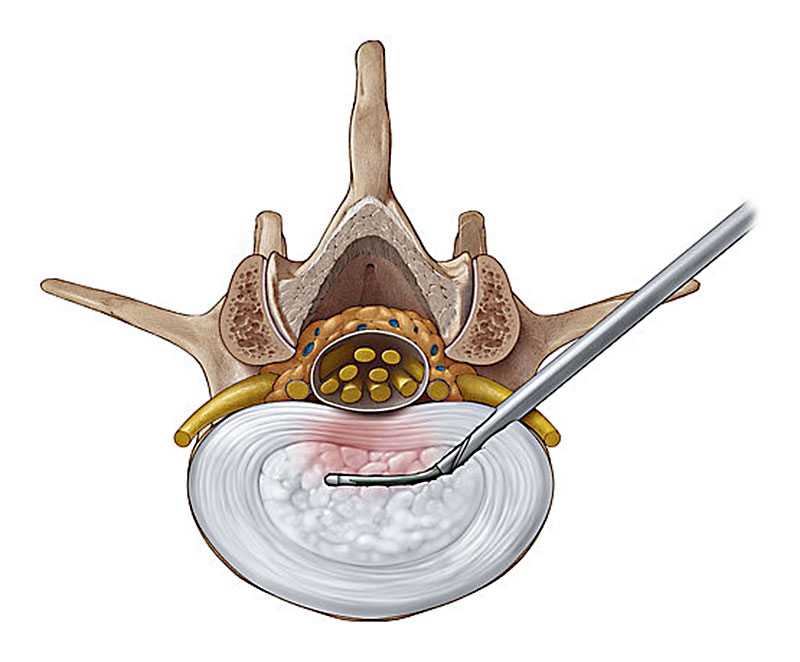 High signal intensity zoneに対する全内視鏡下脊椎手術イメージ