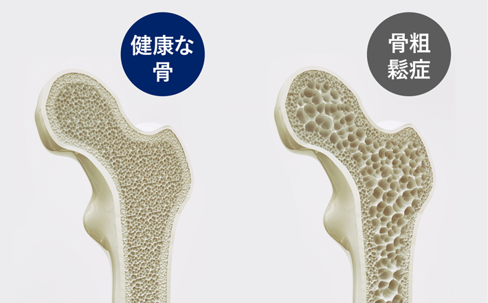 健康な骨と骨粗鬆症の比較画像